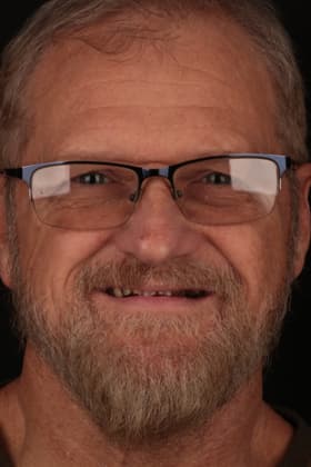 Before and after smile transformation by Advanced Dental Implant and TMJ Center in Southaven, MS.